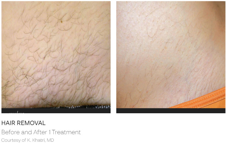 Hair Removal Before & After | ICON