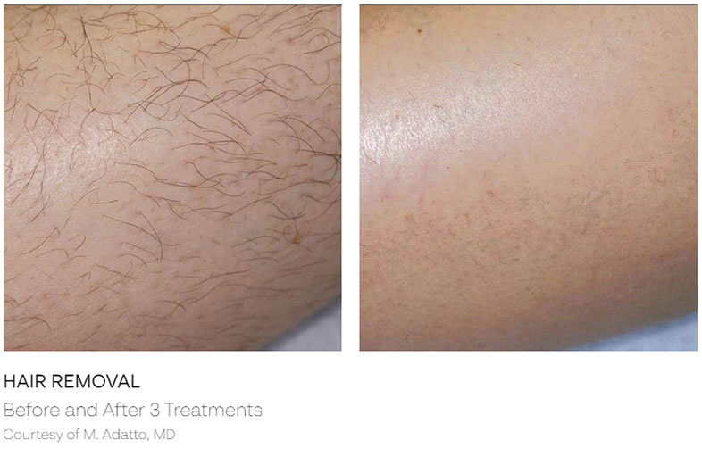 Hair Removal Before & After | ICON