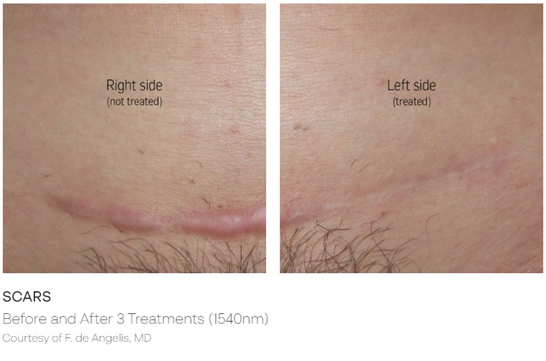Scar Removal Before & After | ICON