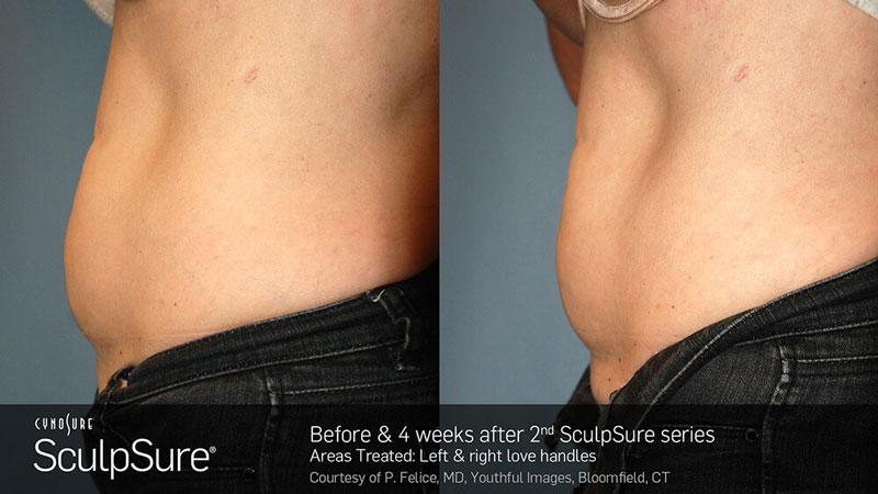SculpSure Before & After