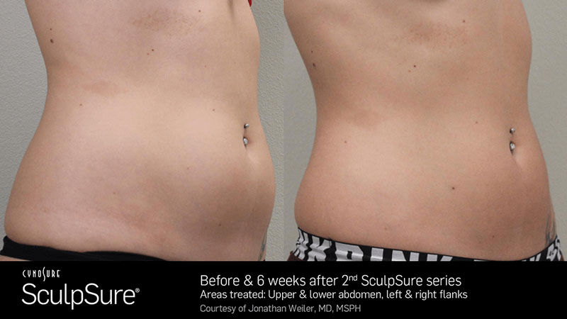 SculpSure Before & After