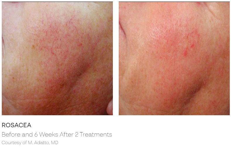 Skin Rejuvenation Before & After | ICON