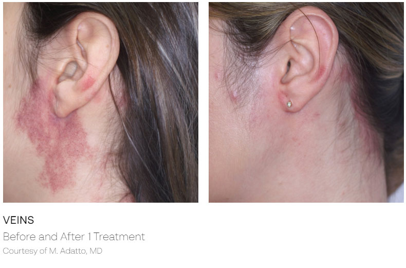 Skin Rejuvenation Before & After | ICON